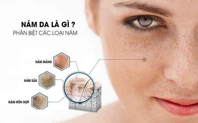 Nám da: Nguyên nhân, dấu hiệu và cách điều trị hiệu quả nhất. 11 Nám da