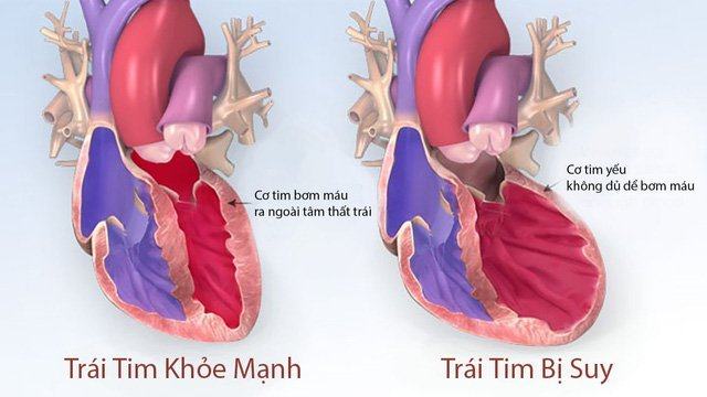 Các bệnh tim mạch thường gặp nhất và cách chữa bệnh tim mạch hiệu quả 20 các bệnh tim mạch thường gặp