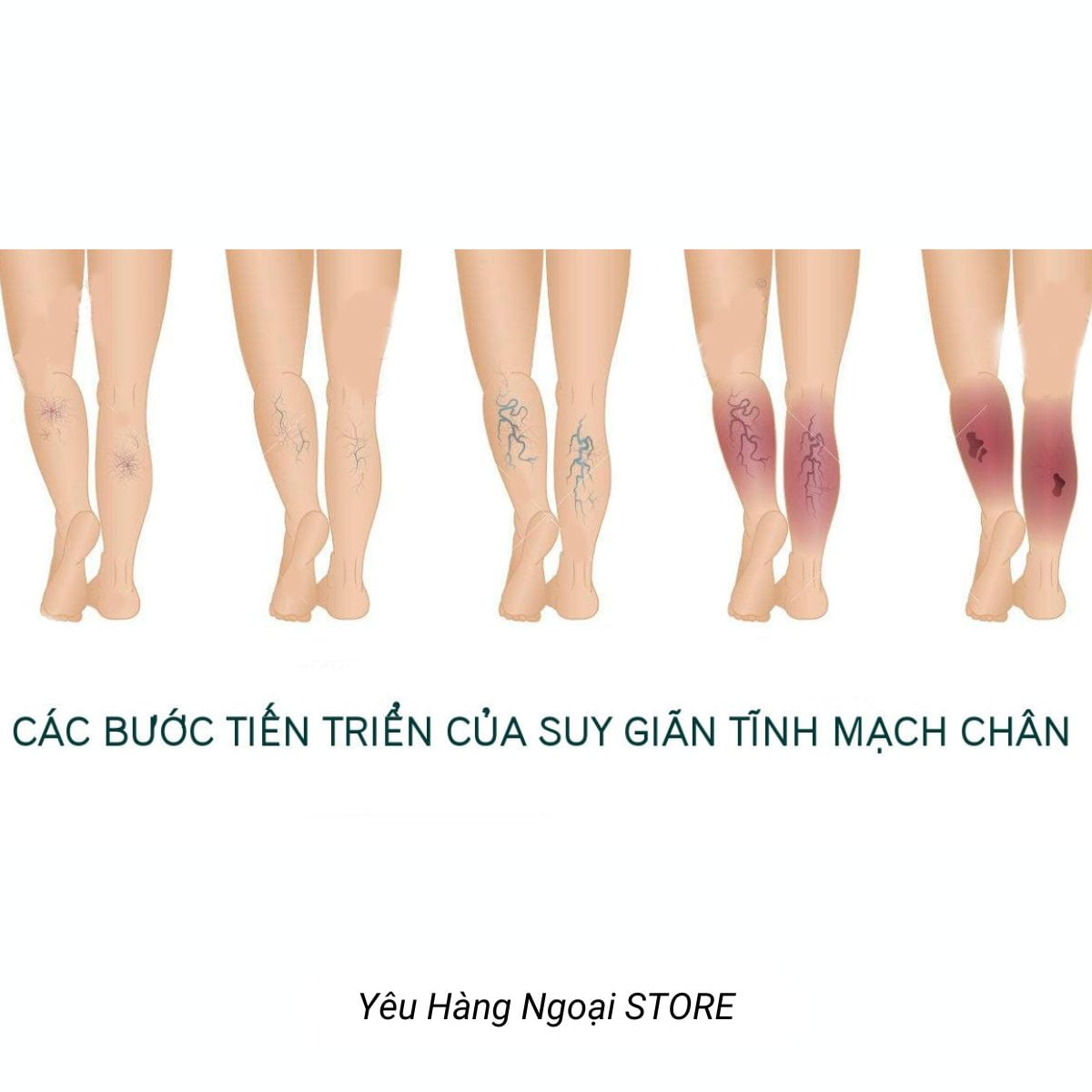 Suy giãn tĩnh mạch chân - 10 Cách trị giãn tĩnh mạch chân tại nhà 7 Suy Gian Tinh Mach Chan