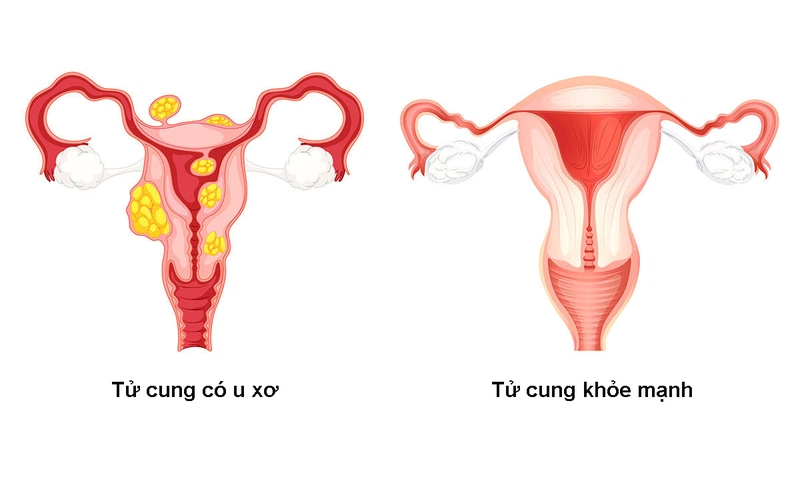 Bị u xơ có uống được collagen không? bi u xo co uong duoc collagen khong
