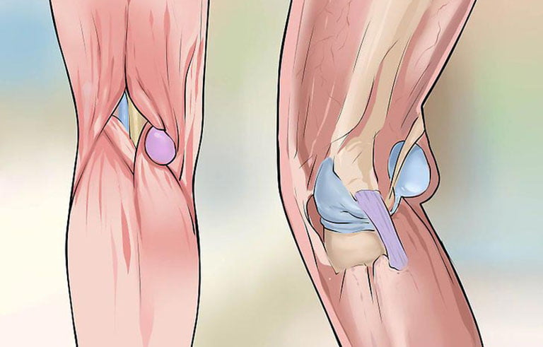 Xương khớp kêu lục cục cảnh báo bệnh gì? 4 Xuong khop keu luc duc