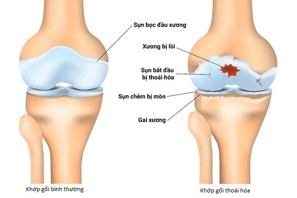 Xương khớp kêu lục cục cảnh báo bệnh gì? 5 Xuong khop keu rac rac
